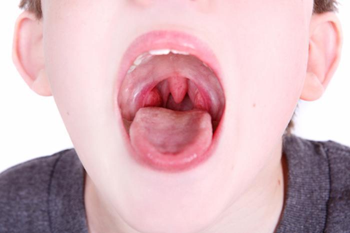 Sore Throat